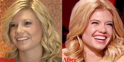 chanel west coast teeth|Chanel West Coast Plastic Surgery Before and After